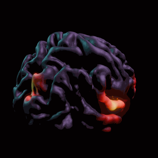 branim demo — brain orbit with stat map overlay